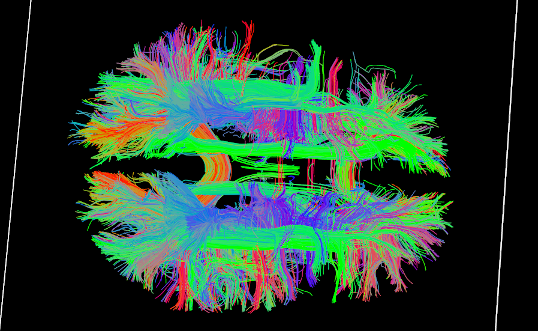 _images/ex_tractography2.png